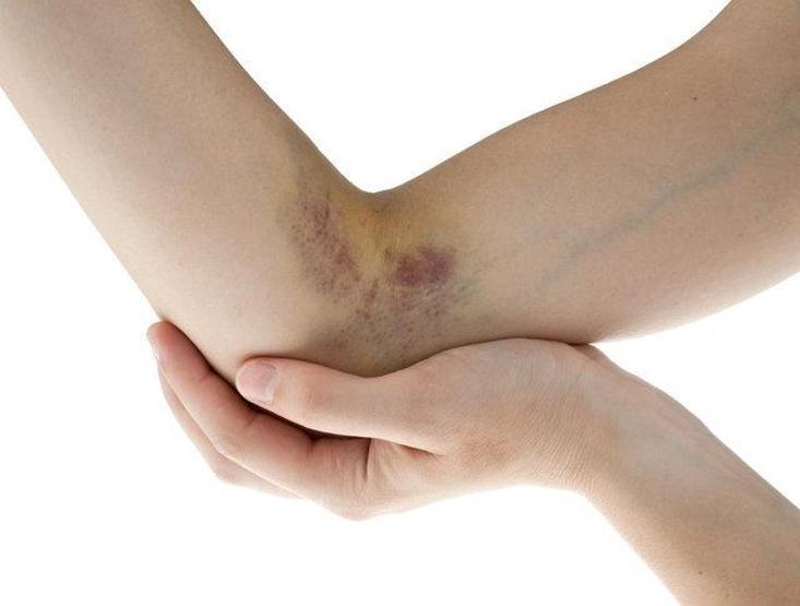Çarpma sonucu morluk oluşsa da dikkat: Bu hastalığa işaret edebilir