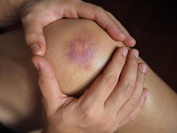 Çarpma sonucu morluk oluşsa da dikkat: Bu hastalığa işaret edebilir