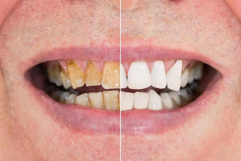 Kanayan diş etlerine C vitamini