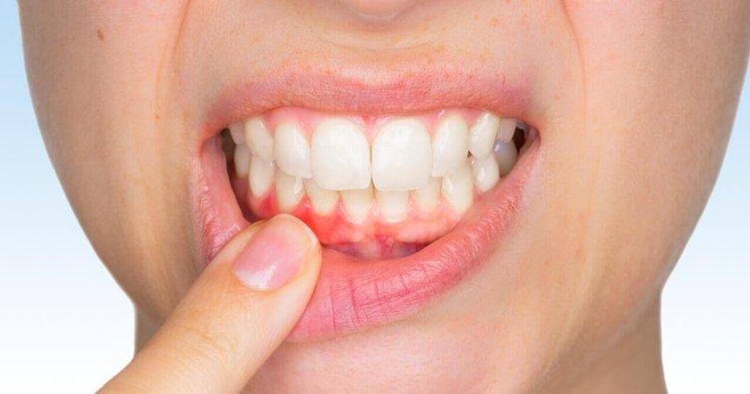 Sağlıklı diş eti ne renk olmalı