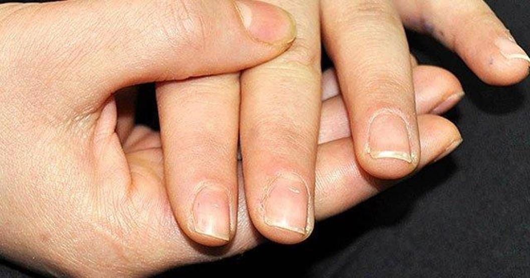 Tırnaklarınıza bir kez daha bakın Böyle görünüyorsa hastalık habercisi