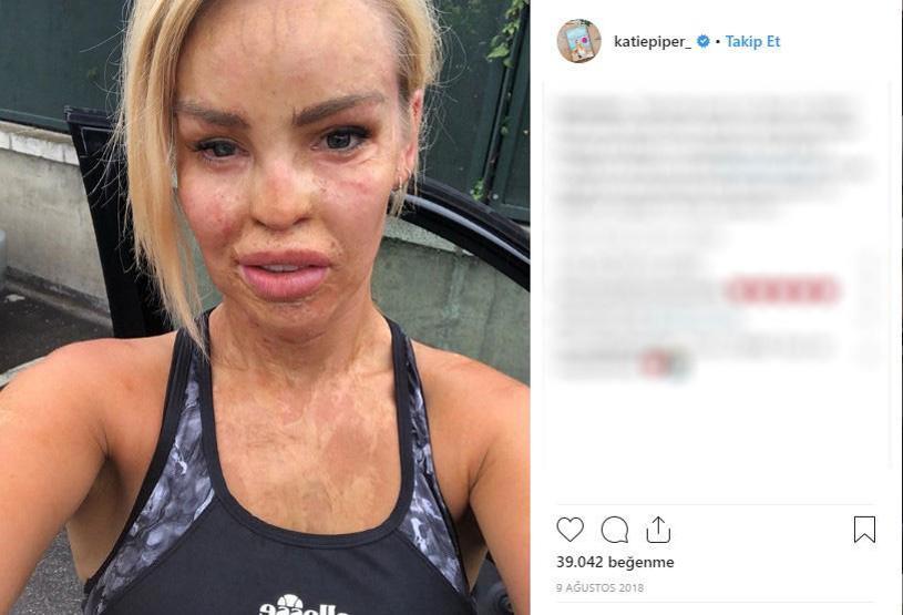 Sevgilisinin asitli saldırısına uğradı, 200den fazla ameliyat geçirdi... Katie Piperın inanılmaz hikayesi