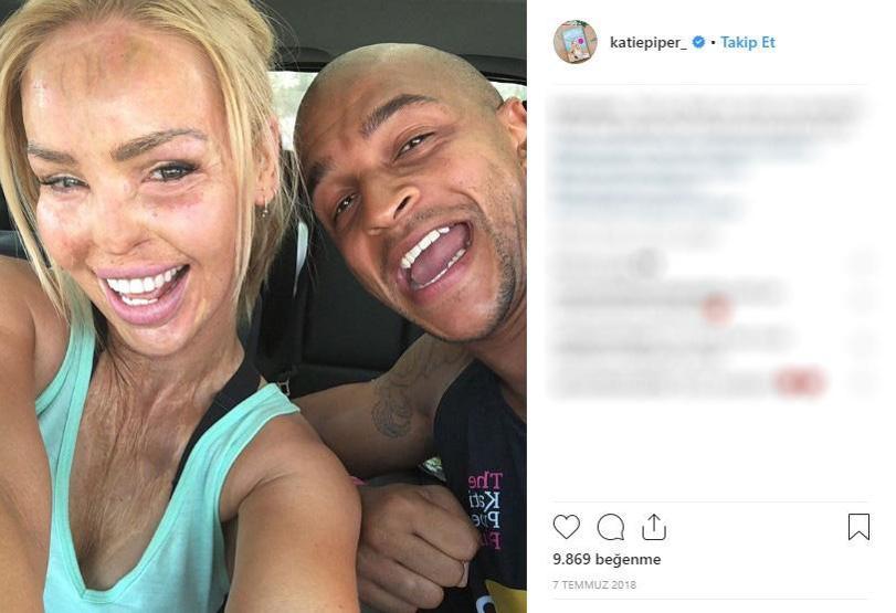Sevgilisinin asitli saldırısına uğradı, 200den fazla ameliyat geçirdi... Katie Piperın inanılmaz hikayesi