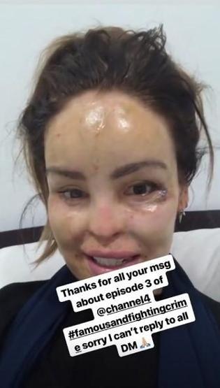 Sevgilisinin asitli saldırısına uğradı, 200den fazla ameliyat geçirdi... Katie Piperın inanılmaz hikayesi