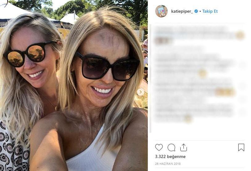 Sevgilisinin asitli saldırısına uğradı, 200den fazla ameliyat geçirdi... Katie Piperın inanılmaz hikayesi