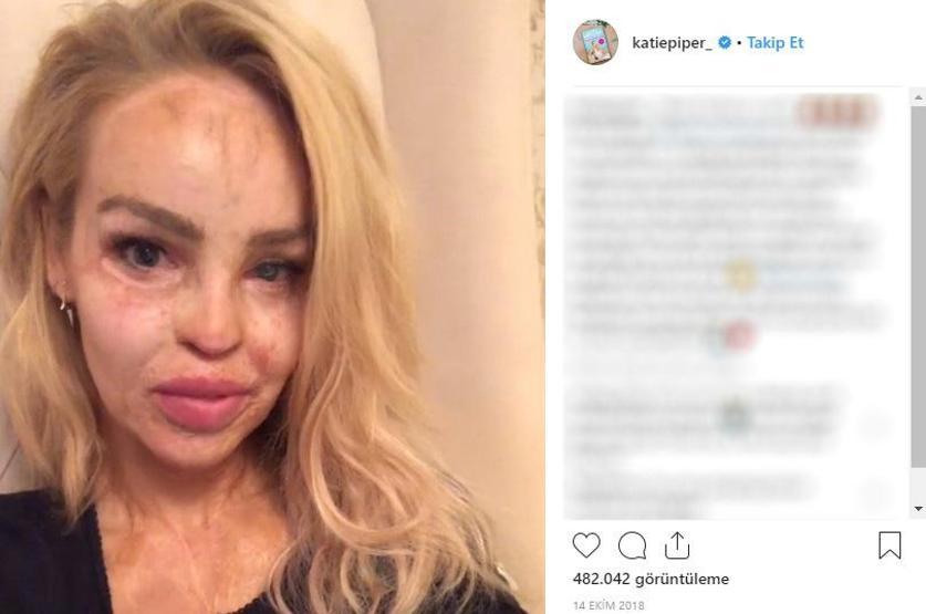 Sevgilisinin asitli saldırısına uğradı, 200den fazla ameliyat geçirdi... Katie Piperın inanılmaz hikayesi