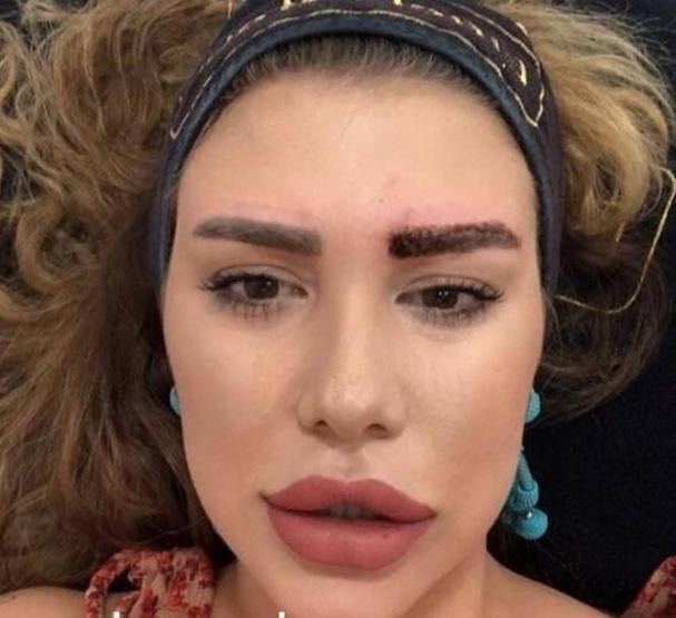 Melis Buse Betkayanın estetikli hali şaşırttı