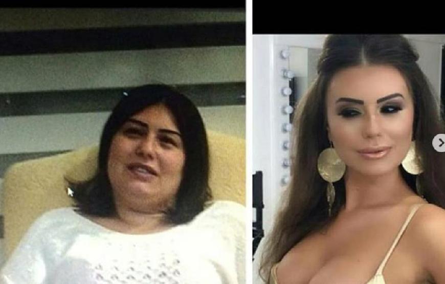 Estetik faciası yaşamıştı 22nci ameliyatını oldu