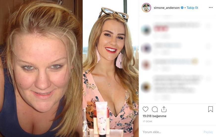 12 ayda 90 kilo verdi... Instagram fenomeninin son halini görenler tanıyamıyor