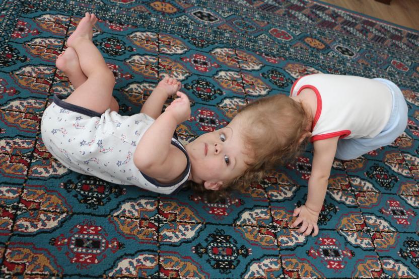 Kafadan yapışık siyam ikizleri 1 yaşında