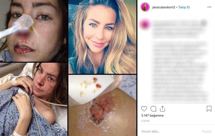 Hayatta istediği her şeye sahipti... Ünlü modelin cildi bu hale geldi, ölümden döndü