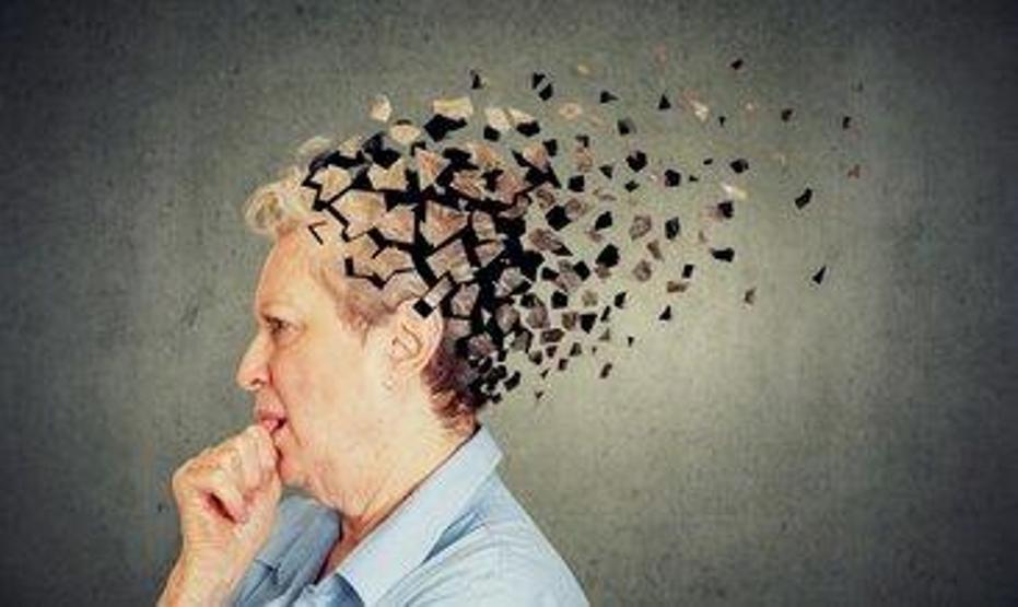 Alzheimer sinsice ilerliyor, ömrü kısaltıyor Kadınlarda risk 2 kat daha fazla...
