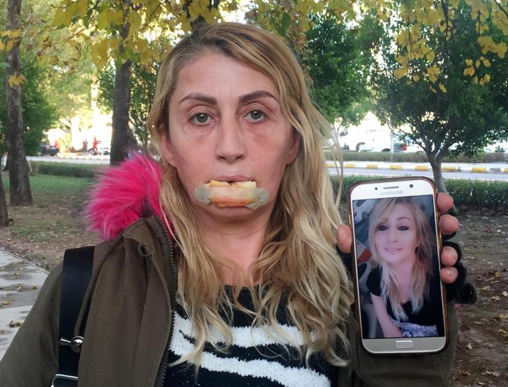 Güzellik uğruna sağlığını kaybetti