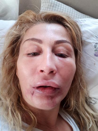 Güzellik uğruna sağlığını kaybetti
