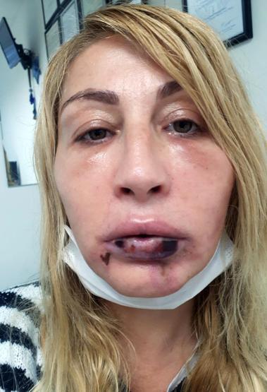 Güzellik uğruna sağlığını kaybetti