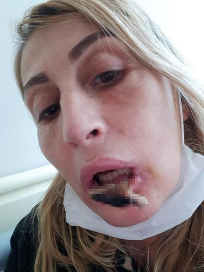 Güzellik uğruna sağlığını kaybetti