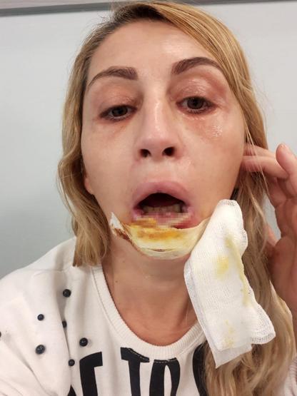 Güzellik uğruna sağlığını kaybetti