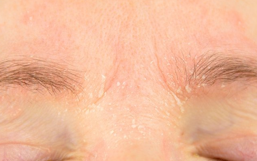 Bağışıklık sisteminin gardını düşüren hastalık; Lupus