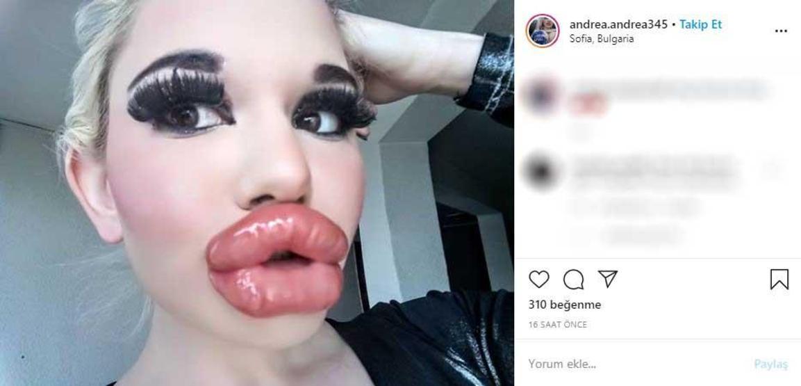 Görenleri şaşkına çevirdi: Barbie’ye özenip 20’den fazla dudak dolgusu yaptırdı