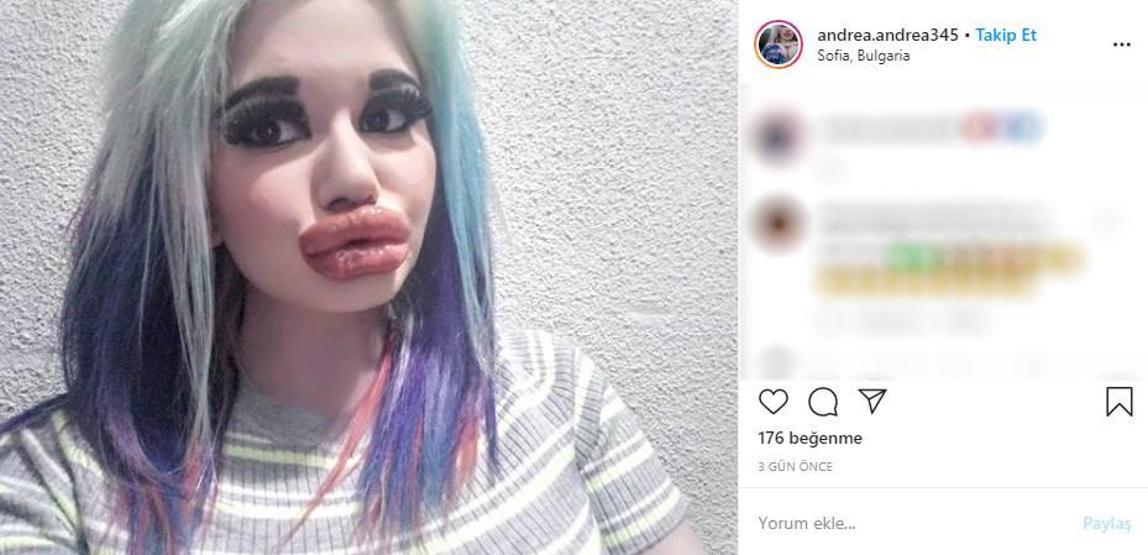 Görenleri şaşkına çevirdi: Barbie’ye özenip 20’den fazla dudak dolgusu yaptırdı