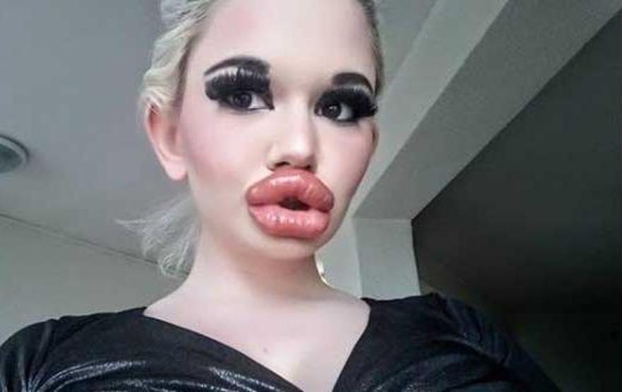 Görenleri şaşkına çevirdi: Barbie’ye özenip 20’den fazla dudak dolgusu yaptırdı