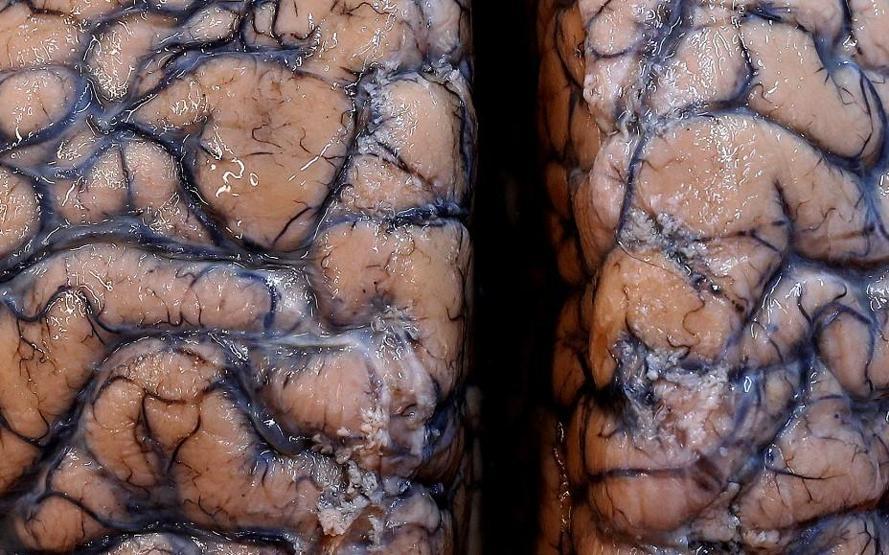 Bilim insanlarından yeni uyarı: COVID-19 bağlantılı beyin hasarı