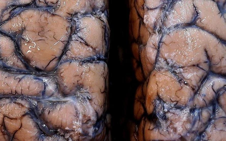 Bilim insanlarından yeni uyarı: COVID-19 bağlantılı beyin hasarı