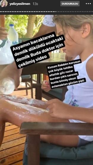 Yeliz Yeşilmenin kızının bacaklarına kaynar su döküldü