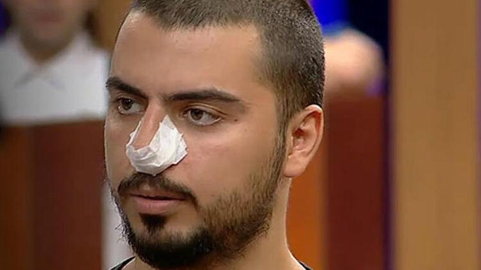 MasterChef Serhatın burnuna ne oldu