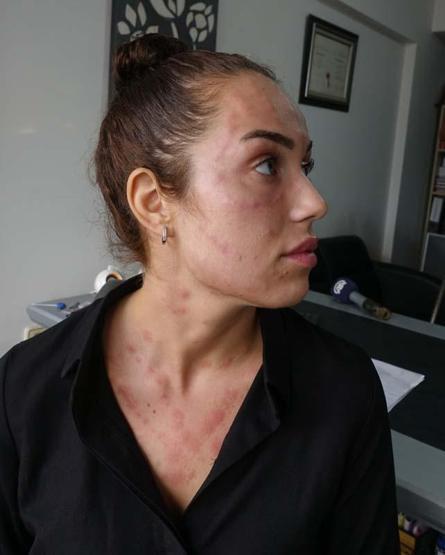 Gençlik aşısı yaptıran kadın hayatının şokunu yaşadı