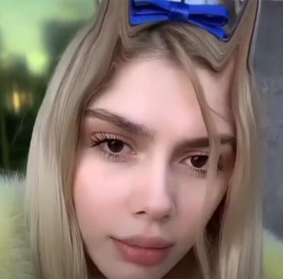 Aleyna Tilkinin yüzünde estetik var mı