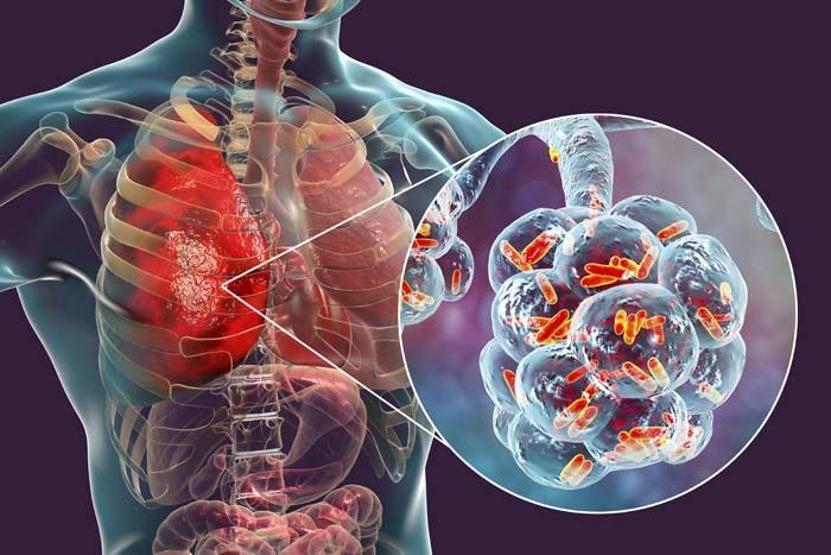 Korkutan uyarı: Covid-19 kötü etkiledi Dünyada veremden ölümler artacak