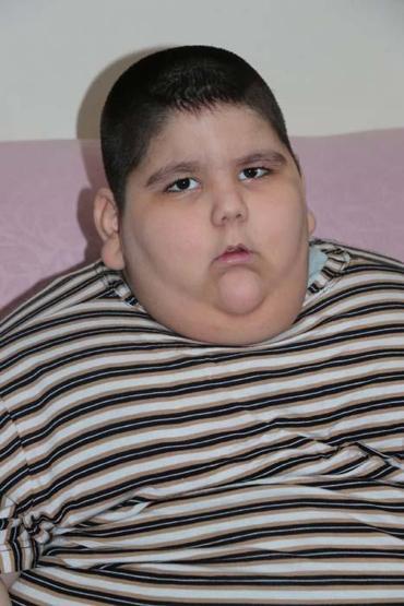 5 yaşındaki Yağız 90 kiloya ulaştı Geceleri solunum cihazına bağlı uyuyor