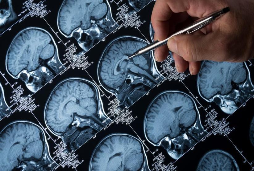 Kanadada gizemli beyin hastalığı alarmı: 5 kişi hayatını kaybetti