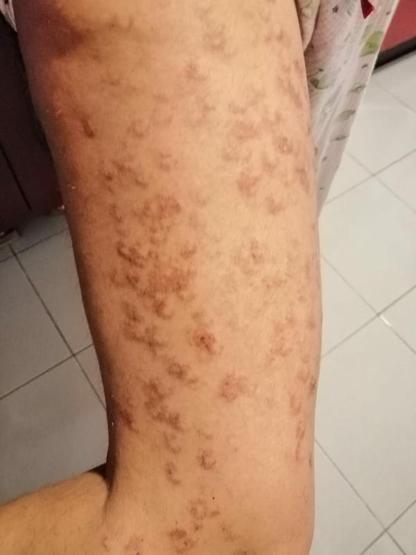 Lazer epilasyonda bacaklarında yanık oluştuğu iddiasıyla şikayetçi oldu