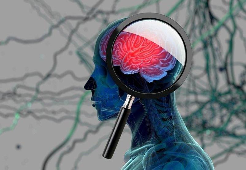 Bu belirtiye dikkat Beyin tümörü vücutta böyle sinyal veriyor