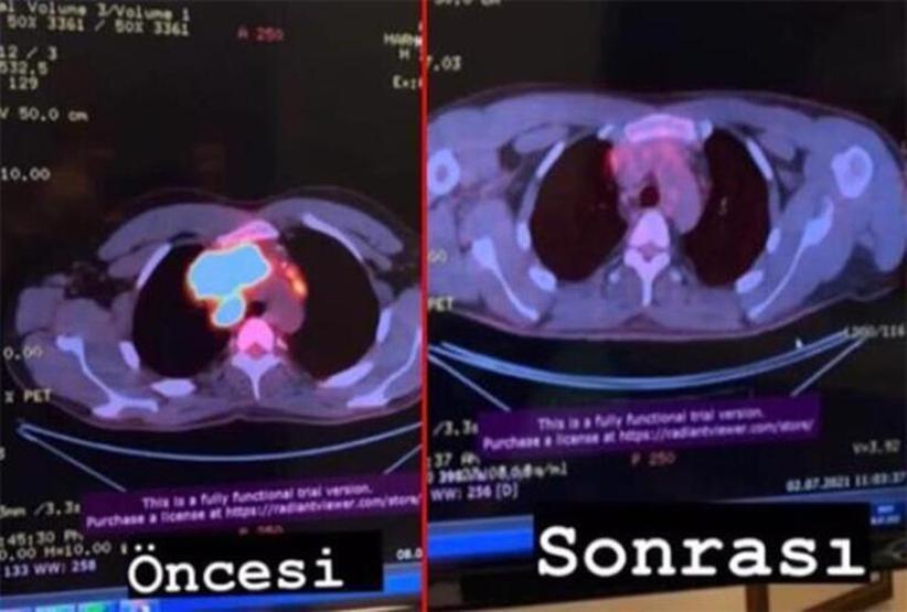Lenf kanseriyle mücadele eden Boğaç Aksoyun tedavisi bitti