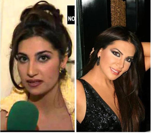 Ebru Yaşarın estetik itirafı dikkat çekti