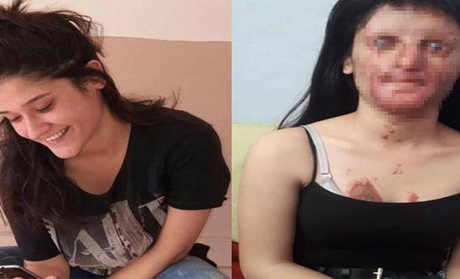 Berfin Özek kimdir, olayı nedir Yüzüne asit atan Casim Ozan Çelik ile evlendi