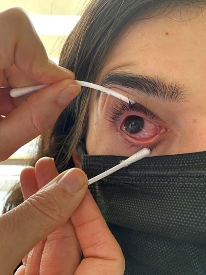 Şimdi de gözlerde virüs salgını