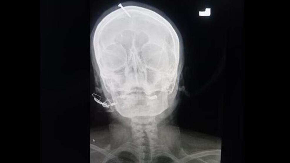Akılalmaz olay Erkek çocuğu olsun diye kafasına çivi çaktılar