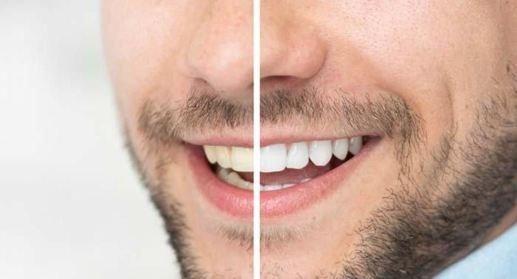 Sağlıklı dişler için 5 etkili öneri