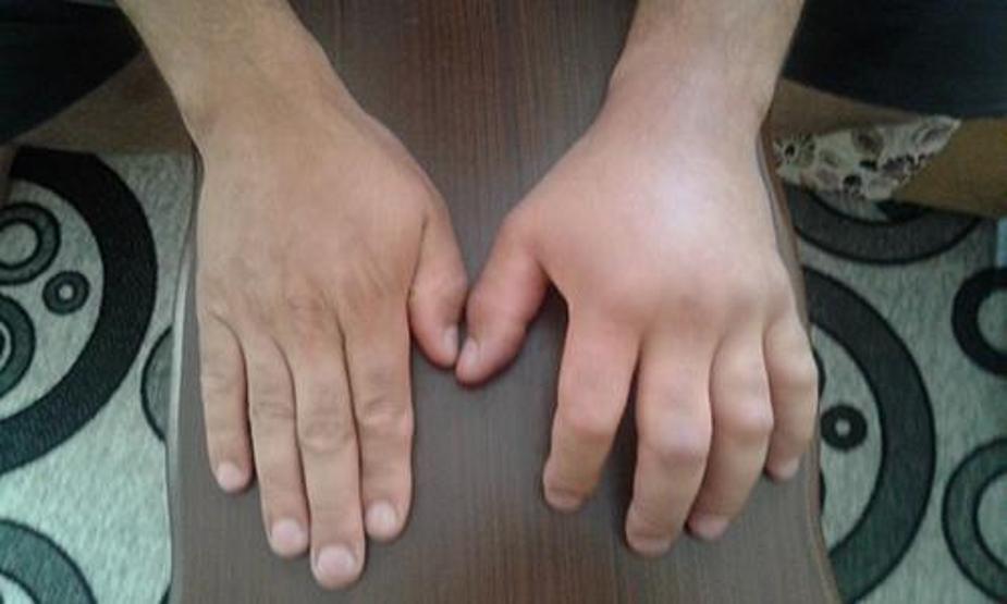 Türkiye’de tanınmayan hastalık: Alerji mi, Herediter Anjiyoödem mi