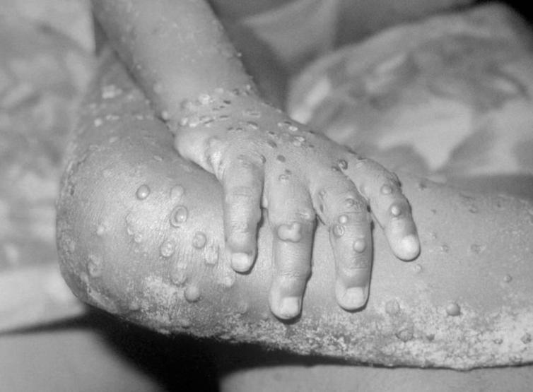 Maymun çiçeği salgınına karantina önlemi… Avrupa’dan peş peşe flaş açıklamalar