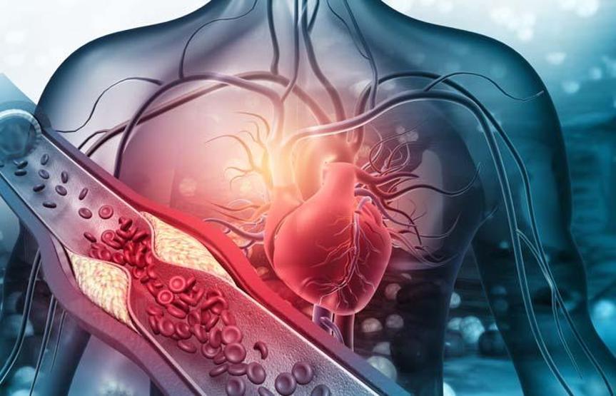 Damar sertliği nedir Damar sertliği belirtileri nelerdir