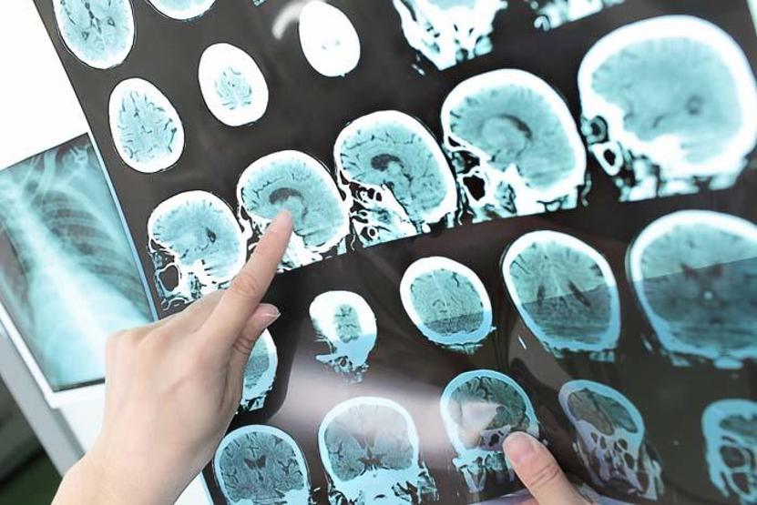 D vitamini eksikliği MS için risk faktörü