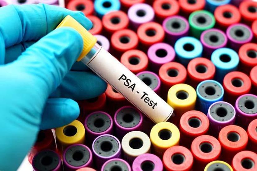 Prostat kanserinde doğru bilinen 10 yanlış
