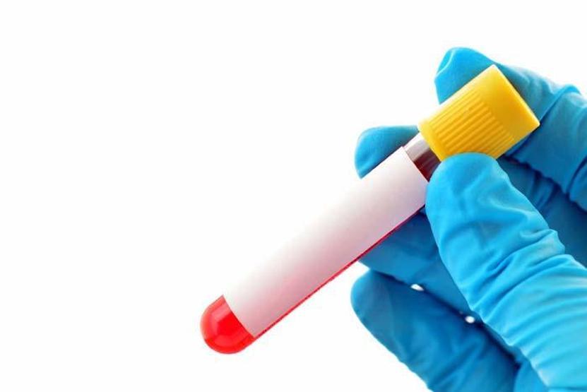 Tırnaklarınızdaki bu değişiklik demir eksikliği anemisinin işareti olabilir Demir eksikliği anemisinin 11 belirtisi