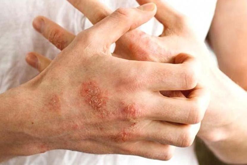 Dermatoloji uzmanından kaşıntı uyarısı