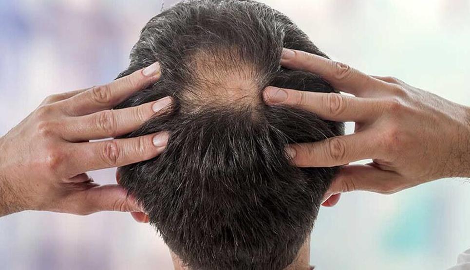 Uzmanından uyarı: Her saç dökülmesine aynı tedavi ile yaklaşmak doğru değil